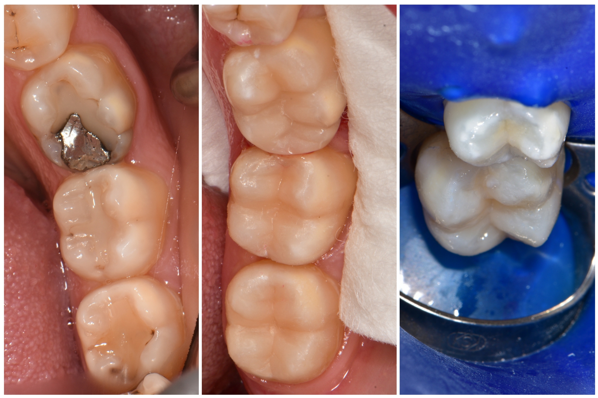 Composite fillings.jpg