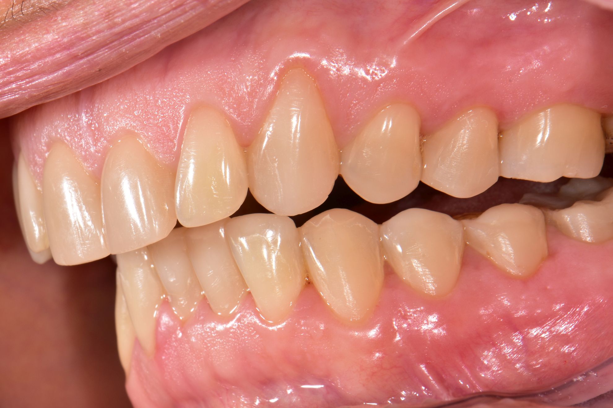 composite reconstruction after.jpg